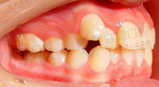 牙套的种类和优缺点（三种牙套区别）(图1)